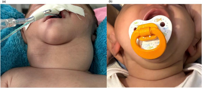 A novel homozygous thyroglobulin gene variant presenting with massive congenital goiter and neonatal airway obstruction