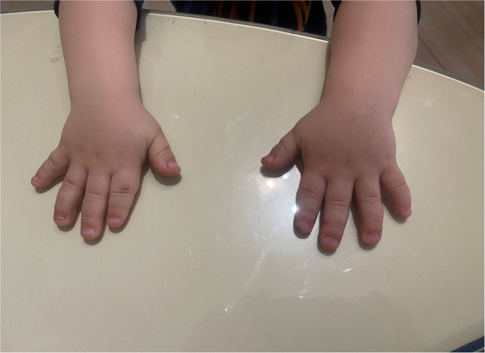 PRKAR1A-related acrodysostosis with partial growth hormone deficiency: 18-month response to recombinant human growth hormone