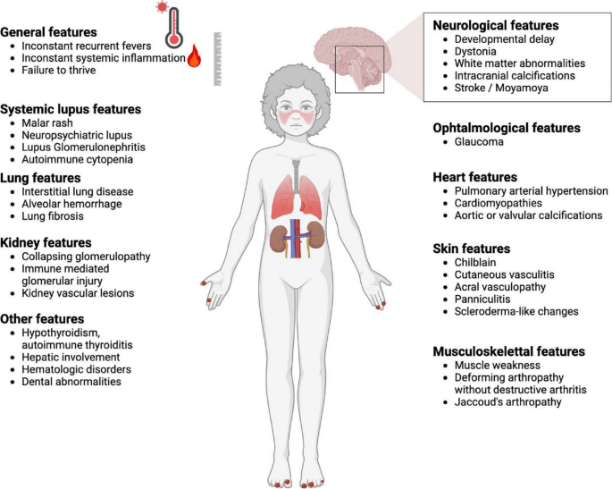 Type I Interferonopathies: Fifteen Years On, From Concept to Therapeutic Perspectives
