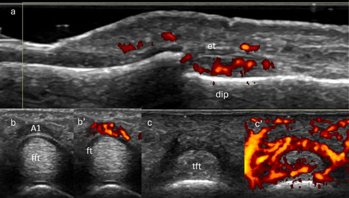 The Role of Musculoskeletal Ultrasound in Psoriatic Arthritis: From Preclinical Detection to Treatment Monitoring