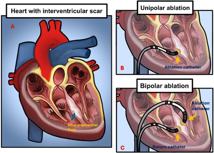 Novel Approaches to Ablation for Ventricular Tachycardia – What Is the Role for Bipolar Radiofrequency Ablation versus Pulsed Field Ablation Targeting Difficult Ventricular Tachycardia Substrates?