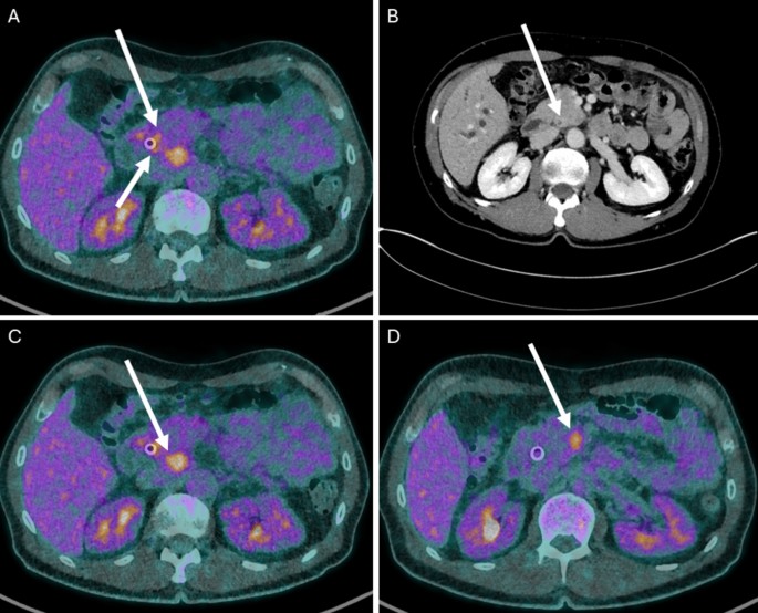 Gastroenteropancreatic Neuroendocrine Carcinoma (GEP-NEC): An Aggressive Disease Course and Limitations for Personalized Oncology