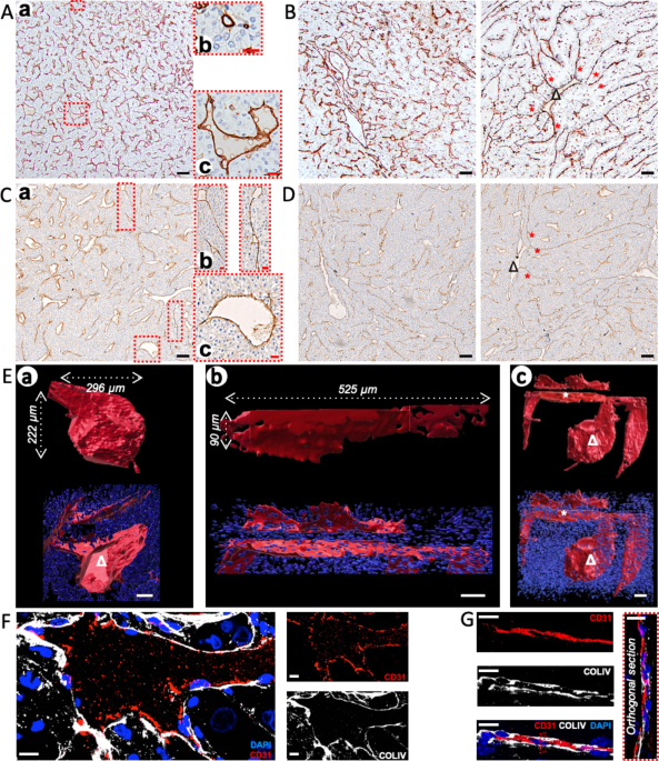 3D co-culture model of tumor spheroid and endothelial cells unveils ccRCC aberrant vasculature and distinct sensitivity to targeted treatments