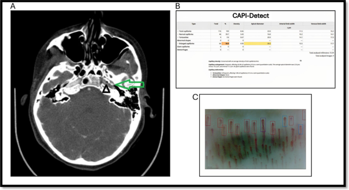 A possible microvascular vulnerability in carotid artery dissection: insights from nailfold capillaroscopy