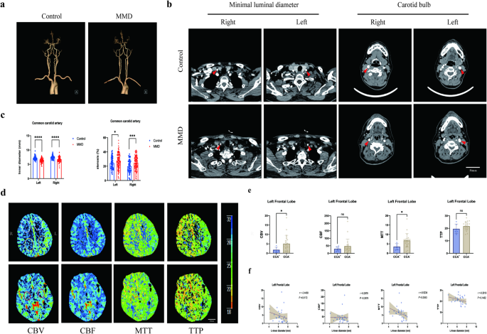 An -deficient hypoperfusion model reveals Moyamoya-relevant neurovascular remodeling