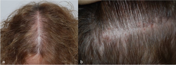 Scalp Rosacea: Current Evidence