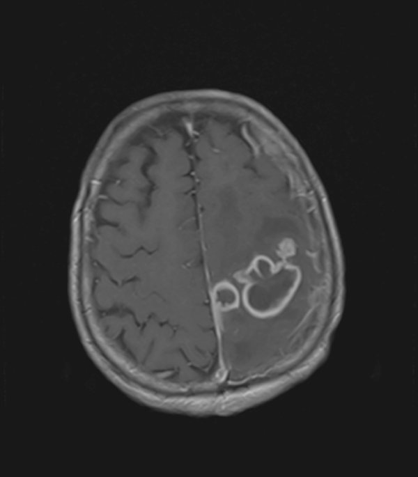 Tuberculous brain abscess mimicking metastatic disease