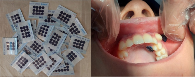 Mucoadhesive patch versus benzocaine gel for reducing injection pain: a split-mouth randomized clinical trial