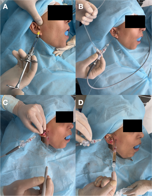 Needle-based level II temporomandibular joint arthroscopy under local anesthesia