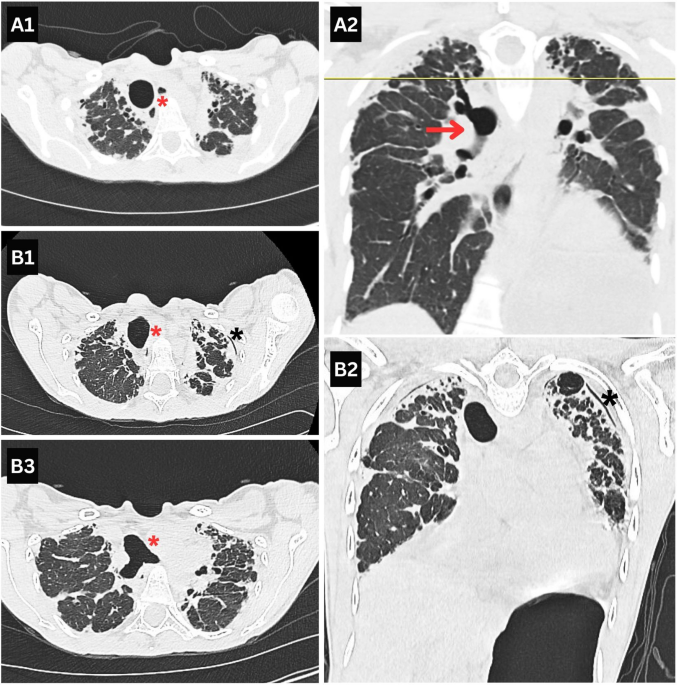 Pleuroparenchymal Fibroelastosis: Clinical Recognition, Risk Stratification, and Management in the Era of Cancer Survivorship