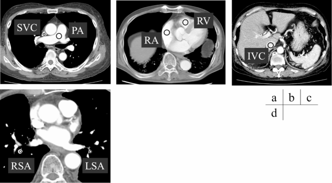 Reduced variability of pulmonary artery enhancement using a single-acquisition combined first-pass and inferior-vena-cava-derived second-pass contrast technique in CT pulmonary angiography