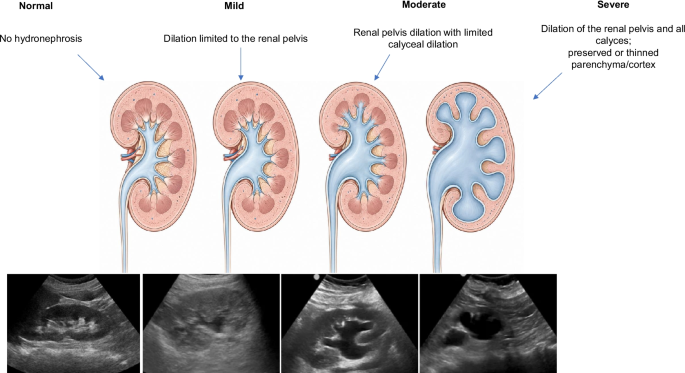 Agreement between emergency medicine residents and a radiologist in ultrasonographic detection and grading of hydronephrosis in patients with suspected renal colic: a prospective study