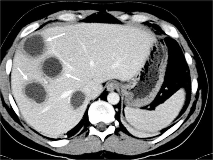 Hepatic abscess on CT: pearls, pitfalls and diagnostic challenges