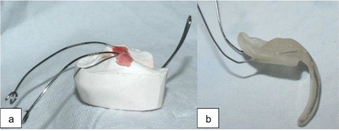 Clinical experience and functional outcomes of infants with Pierre Robin sequence treated with the Tübingen palatal plate: a retrospective case series from a multidisciplinary tertiary care setting