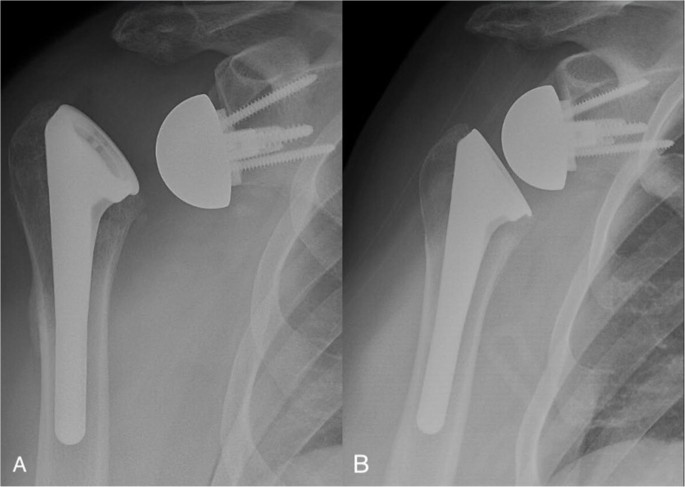 Instability After Reverse Shoulder Arthroplasty: Evaluation, Diagnosis, Management