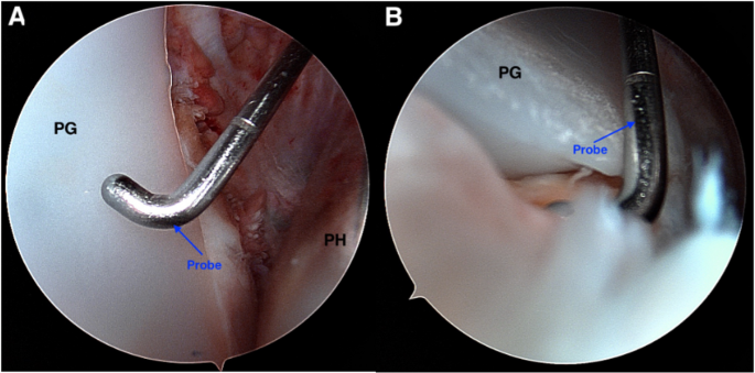 Arthroscopy for the Painful Shoulder Arthroplasty: Indications, Outcomes, and Technical Considerations