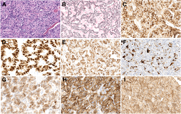 A Cauda Equina Neuroendocrine Tumor with Tyrosine Hydroxylase Expression