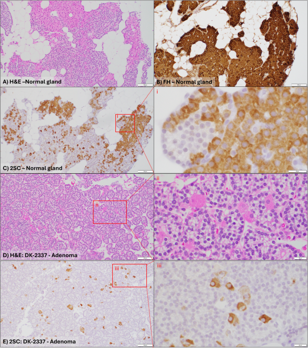 Expansion of Germline Variants in Primary Hyperparathyroidism: Fumarate Hydratase Deficiency as a Cause of Parathyroid Adenomas