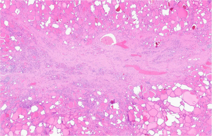 Prevalence and Histologic Features of Multifocal Fibrosing Thyroiditis in the Routine Pathology Practice