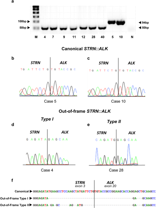 Distinct ALK Expression Patterns Are Associated with Canonical and Noncanonical  Transcript Architectures in Oncocytic Thyroid Neoplasms