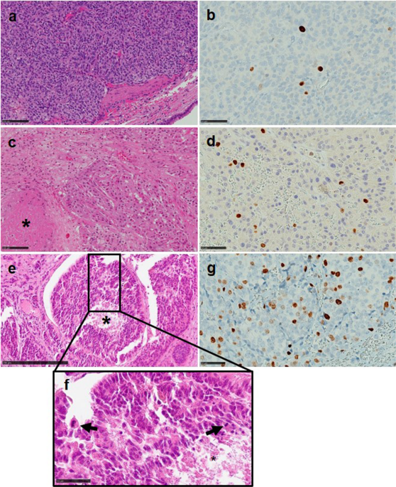 Three-Tier Prognostic Stratification of Lung Carcinoids (NET G1-G2-G3) by Multivariable, Data-Driven Integration of Ki-67 and Mitotic Count