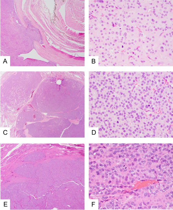 Clinicopathologic and Molecular Features of Poorly Differentiated Thyroid Carcinomas in Adults ≤ 45 Years of Age