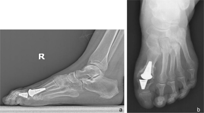 Long-term clinical, functional and radiological outcomes after total arthroplasty of the first metatarsophalangeal joint in the treatment of hallux rigidus