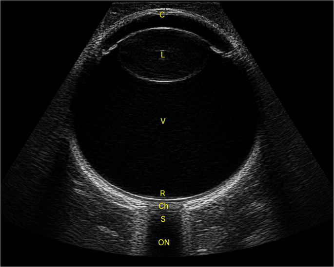 Point-of-Care Ultrasound for the Detection of Ocular Emergencies in the Acute Care Setting: a Practical and Evidence-Based Review