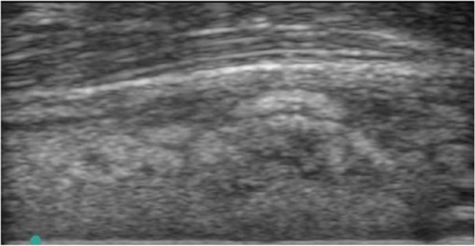 Recent Advances in the Diagnostic Imaging of Cellulitis in the Emergency Department