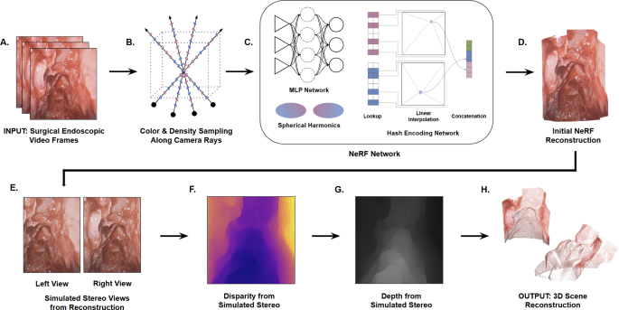 Virtual intraoperative CT (viCT): sequential anatomic updates for modeling tissue resection throughout endoscopic sinus surgery