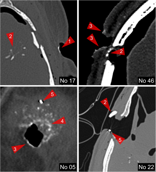 Radiopaque ring sign as a distinct finding at the entry site of gunshot wounds on postmortem CT