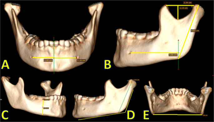 Sex estimation from the mandible in 3D computed tomography images
