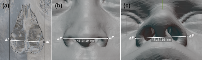 Nose-skull relationships for craniofacial identification: computed tomography (CT) assessment of nose width, nasal bridge shape & pronasale position