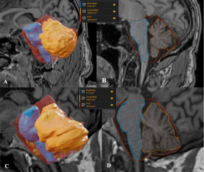 Age-Related Volumetric Changes of the Posterior Cranial Fossa and its Structures in Stroke Patients