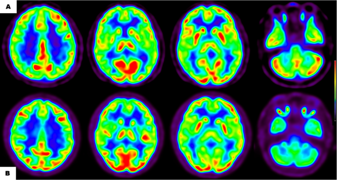 Multimodal PET Imaging Unveils Early Metabolic Compensation Mechanisms and Dopaminergic Degeneration in Parkinson’s Disease