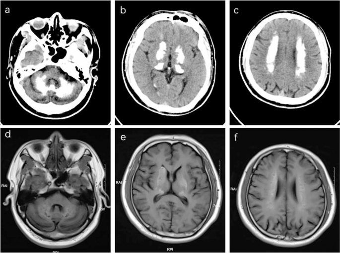 Multimodal PET Findings in -Related Primary familial Brain Calcification Caused by a Novel Homozygous Frameshift Mutation