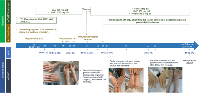 Belumosudil for acute GVHD after allogeneic hematopoietic stem cell transplantation: a retrospective case series