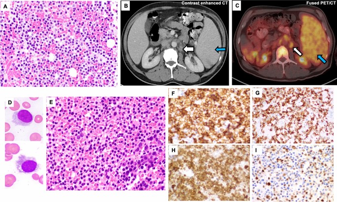 Unusual presentation of hairy cell leukemia as a retroperitoneal nodal mass: a diagnostic pitfall