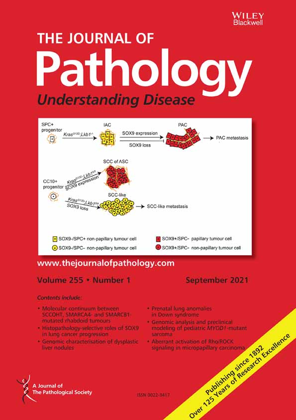 Calcyphosine promotes the proliferation of glioma cells and serves as a potential therapeutic target