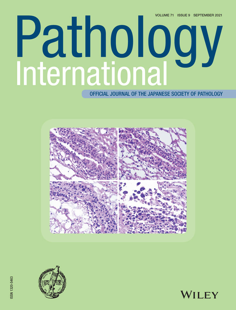 The first case of gastric leiomyosarcoma developed through malignant transformation of leiomyoma