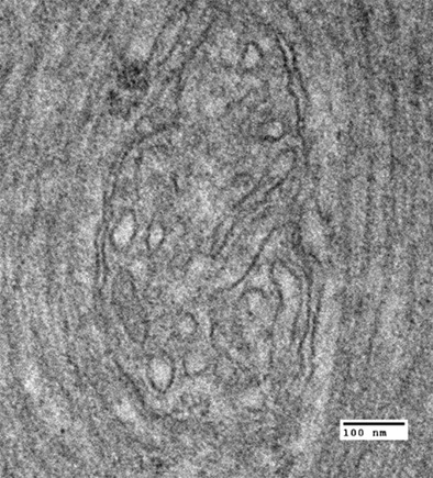Mitochondrial Developmental encephalopathy with bilateral optic neuropathy related to homozygous variants in IMMT gene
