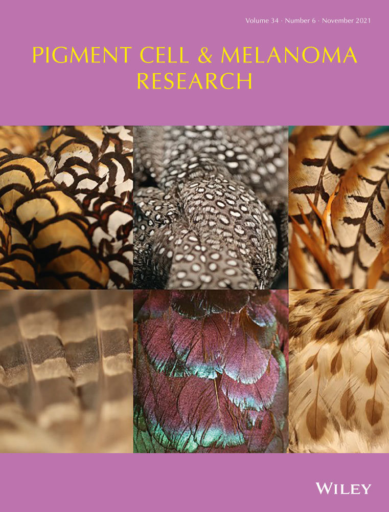 Volar location and degree of pigmentation are associated with poor survival and first metastasis pattern in acral melanoma