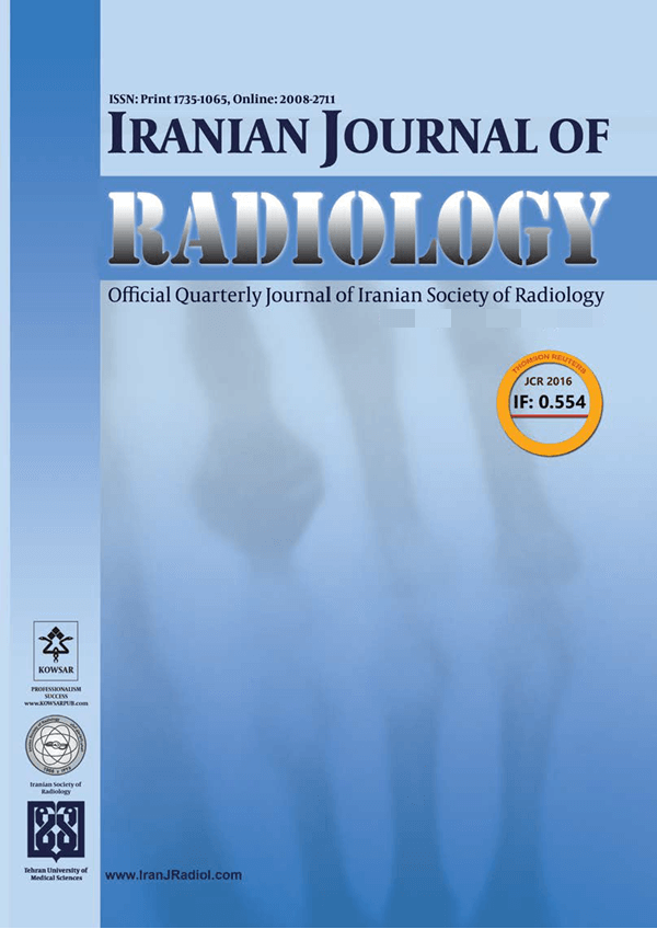 Azygos Vein Aneurysm as a Posterior Mediastinal Mass Discovered After Minor Chest Trauma