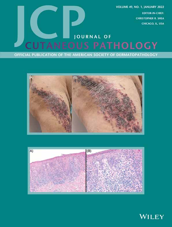 Malignancy‐Associated Acquired Vulvar Lymphangioma Circumscriptum: A Clinicopathologic Study of 71 Cases