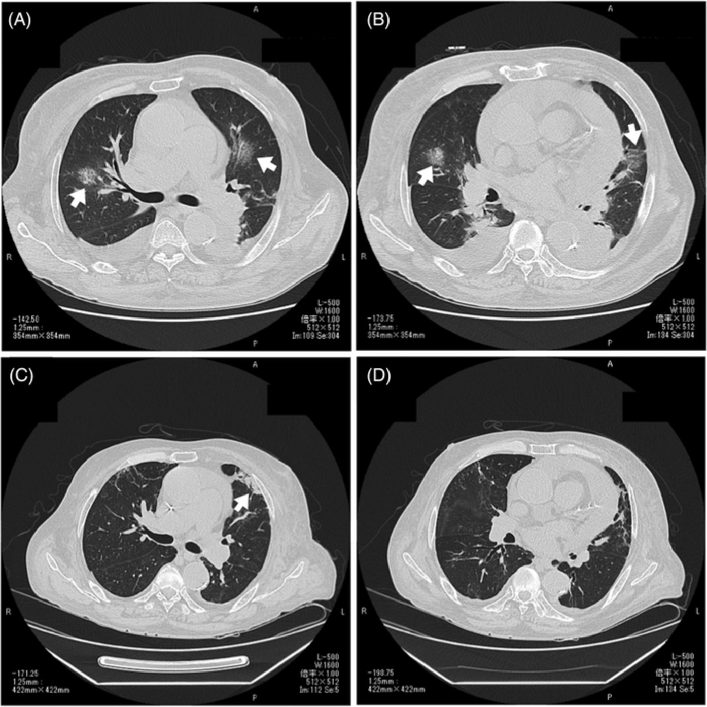 A case of effective intravenous methylprednisolone pulse therapy against severe COVID‐19 infection after arteriovenous graft surgery