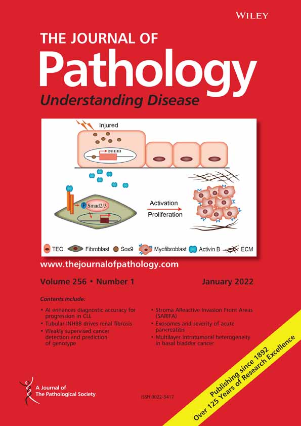 Neutrophil extracellular traps drive epithelial‐mesenchymal transition of human colon cancer