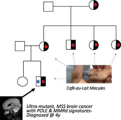 Di‐genic inheritance of germline POLE and PMS2 pathogenic variants causes a unique condition associated with pediatric cancer predisposition