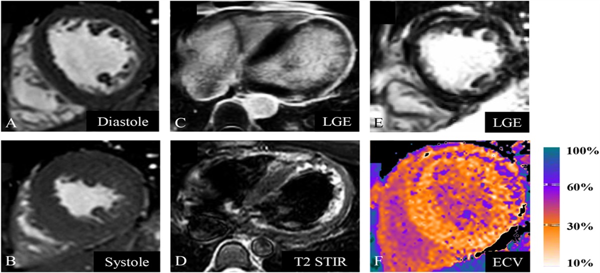 Post–COVID-19 Cardiovascular Evaluation in National Collegiate Athletic Association Division I Athletes