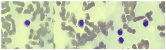 JCM, Vol. 12, Pages 193: A Frail Hairy Cell Leukemia Patient Successfully Treated with Pegylated Interferon-&alpha;-2A