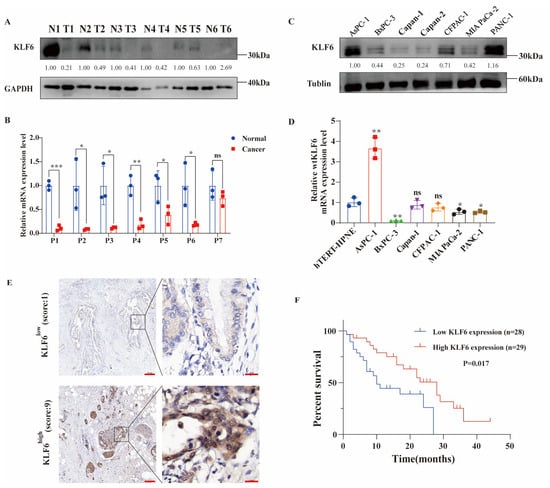 JCM, Vol. 12, Pages 200: Kr&uuml;ppel-like Factor 6 Suppresses the Progression of Pancreatic Cancer by Upregulating Activating Transcription Factor 3